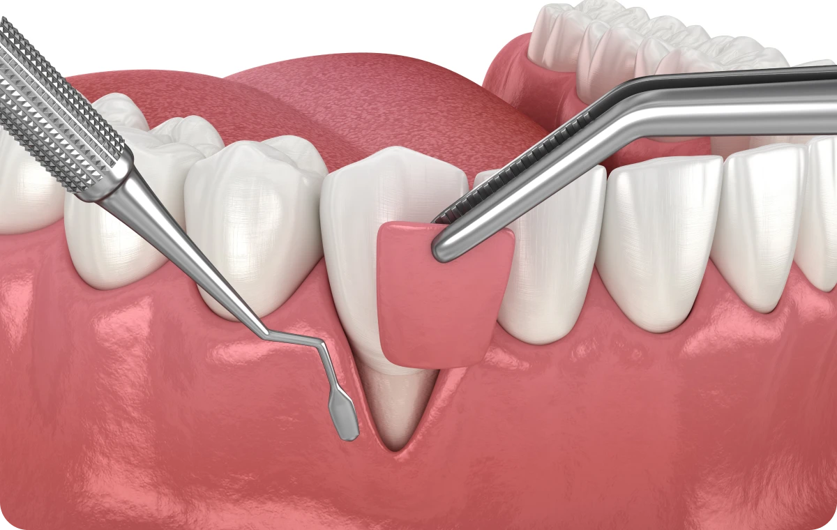 greffe-gingivale-tourcoing-modernes