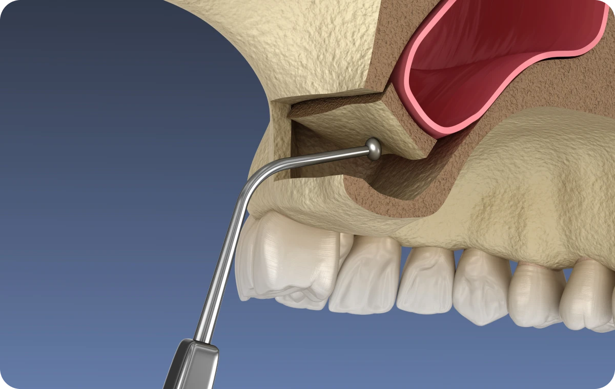 sinus-lift-tourcoing