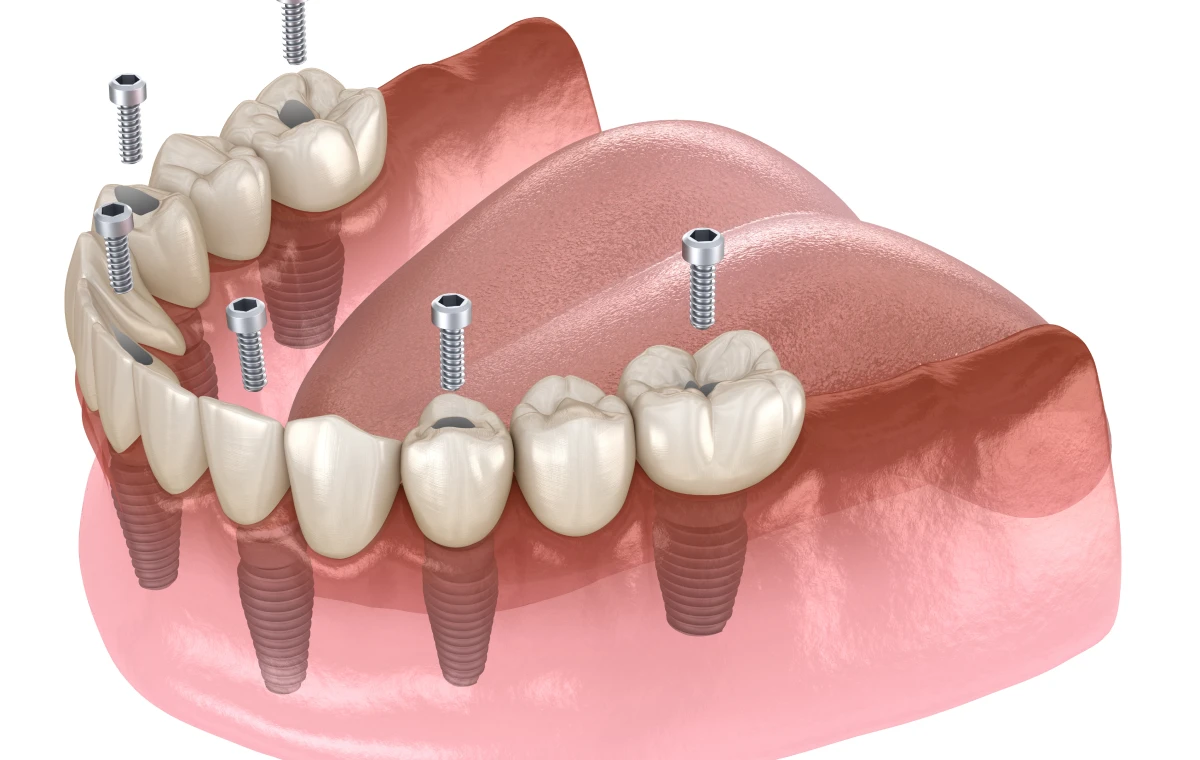 solutions-dentaires-tourcoing-efficaces