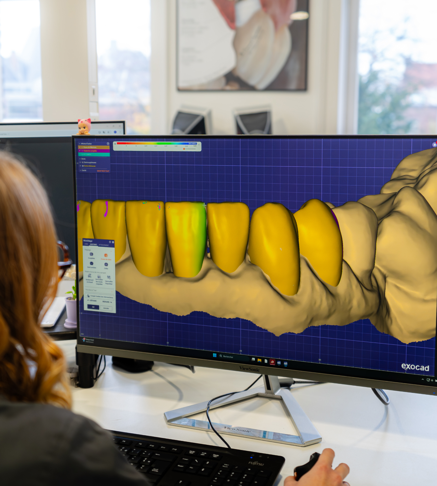 implants-dentaires-tourcoing-stabilite-osseuse